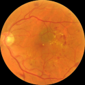 Diabetic retinopathy predictor