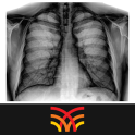 Chest Radiographs