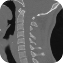 CT Cervical Spine