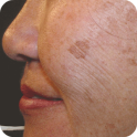 Age Spot Removal Home Remedy
