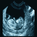 Ultrasound Abdomen + OBGYN Boards Flashcards