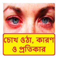 চোখ উঠলে তার চিকিৎসা ~ Eyes Disease Treatment