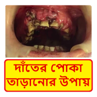 দাঁতে পোকা সমস্যা ~ Tooth Problems Treatment