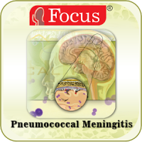 Pneumococcal meningitis