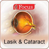 Lasik and Cataract
