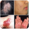 All Skin Diseases and Treatment- A to Z